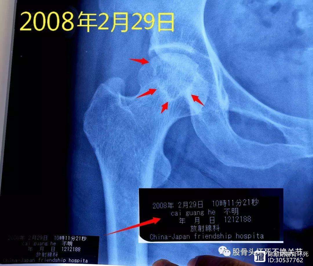 张家口人工骨头医保报销多少(人工骨头医保报销多少比例)