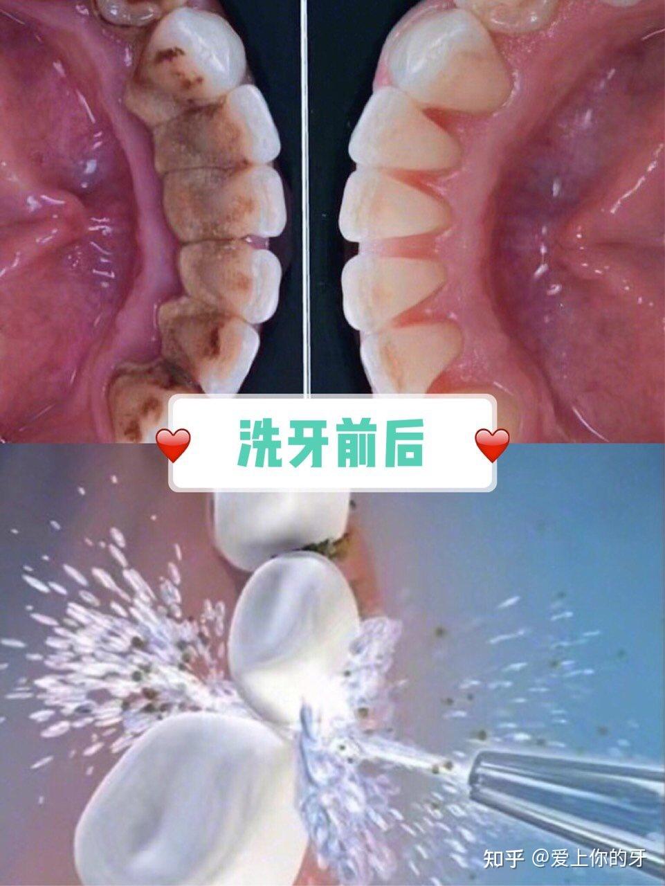 张家口洗牙可以用医保吗(洗牙可以用医保吗,报销比例多少)